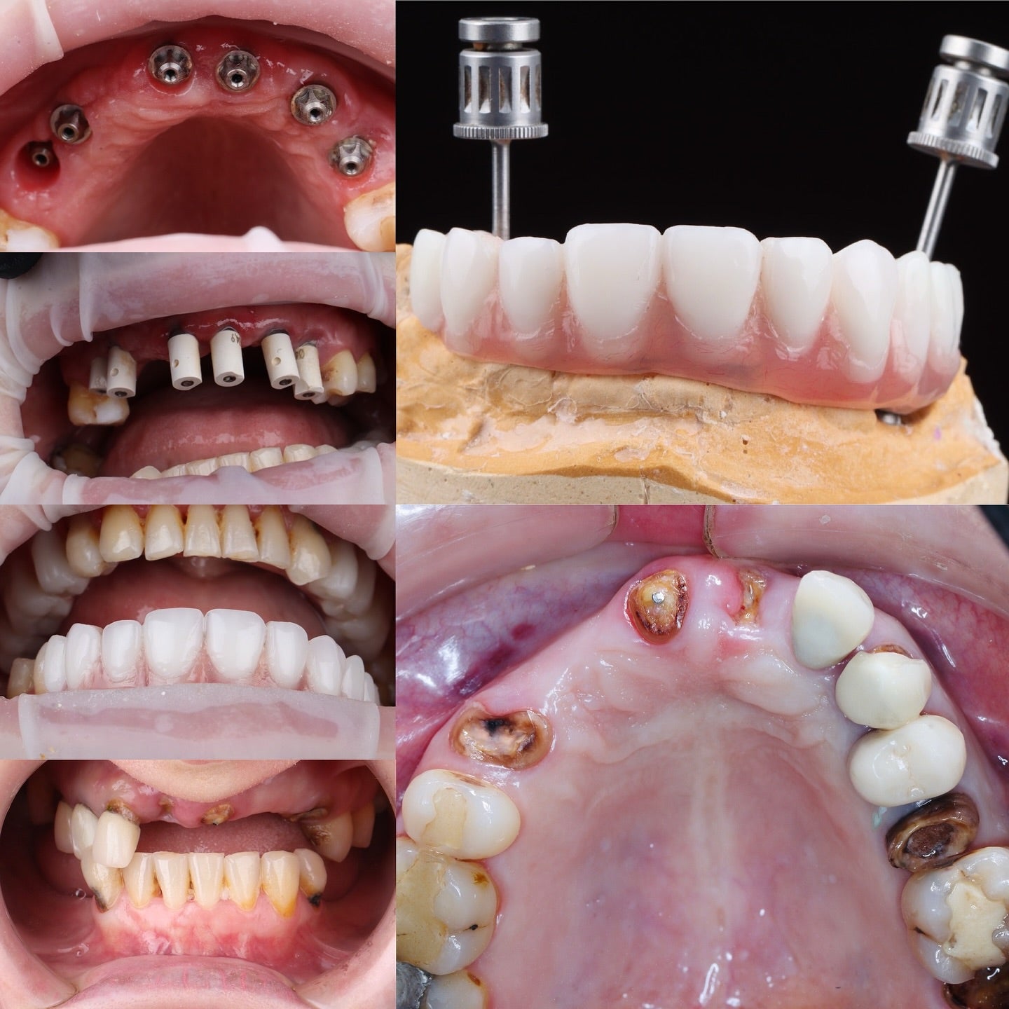 Immediate implant MASTERY