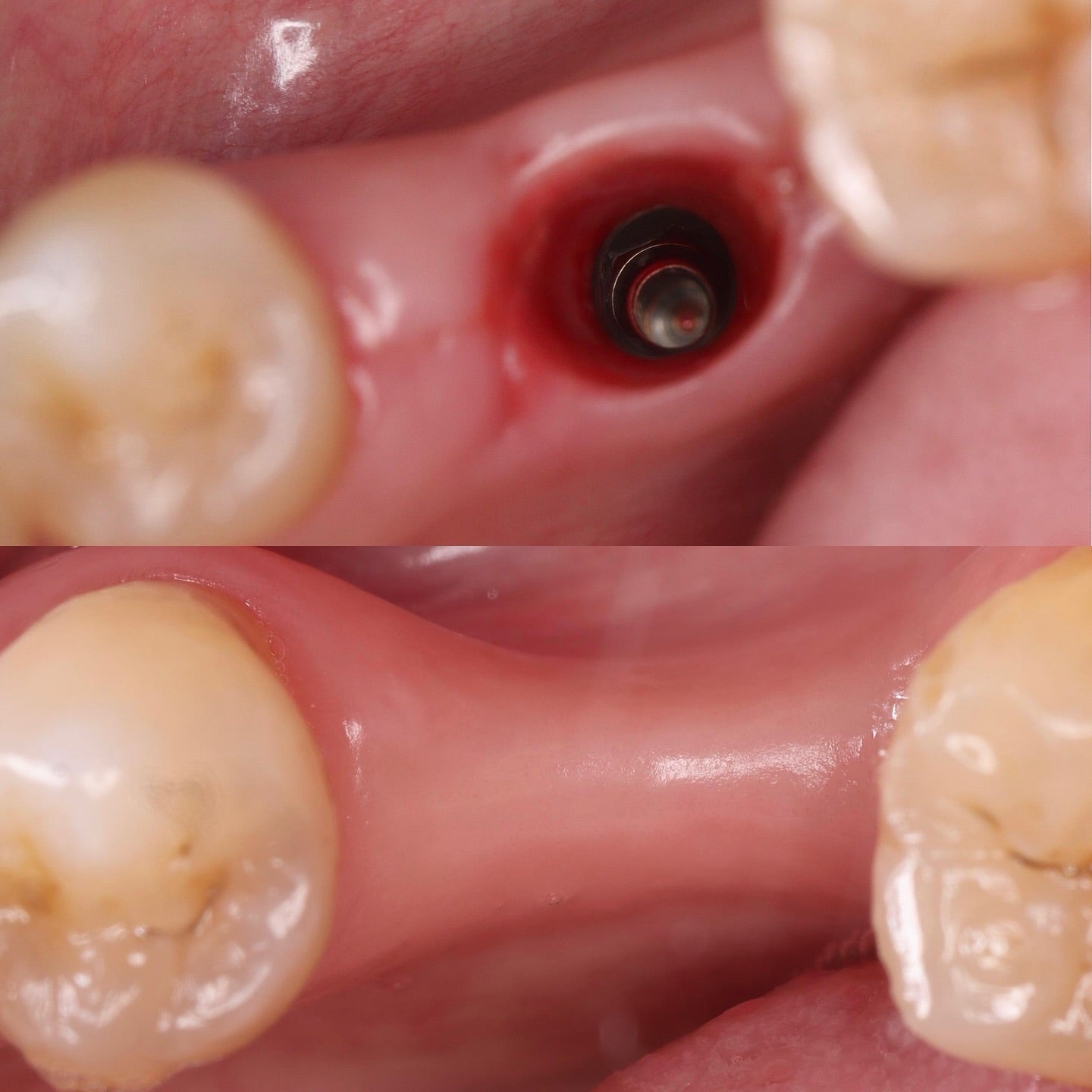 Immediate implant MASTERY