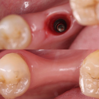 Immediate implant MASTERY