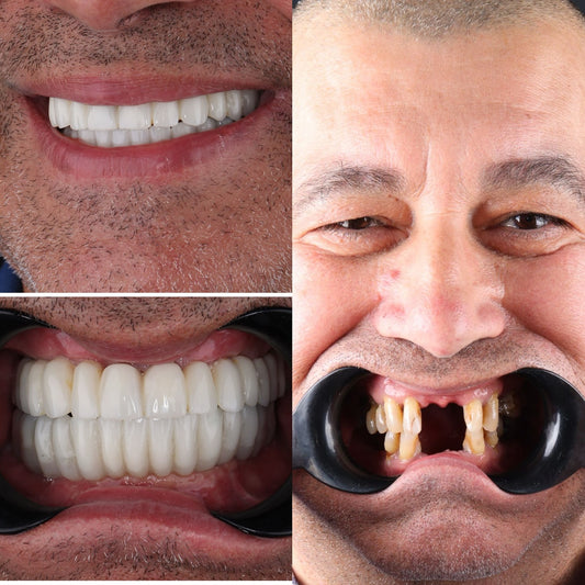 Immediate implant MASTERY