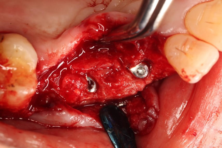 Immediate implant MASTERY